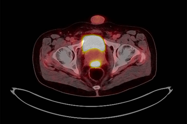 PSMA Pet CT